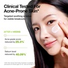 image:imageAnua Azelaic Acid Soothing Duo Azelaic Acid Hyaluron Redness Soothing Serum amp CICA Skin Soothing Moisturizer Lightweight amp Hydrating Serum with Moisturizer Korean Skincare