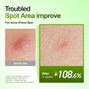 image:imageAnua Spot Correcting amp Clarity Duo Azelaic Acid Hyaluron Soothing Serum amp Niacinamide TXA Toner for BlemishProne amp OilyProne Skin Lightweight amp Hydrating Glow Skin Korean Skincare